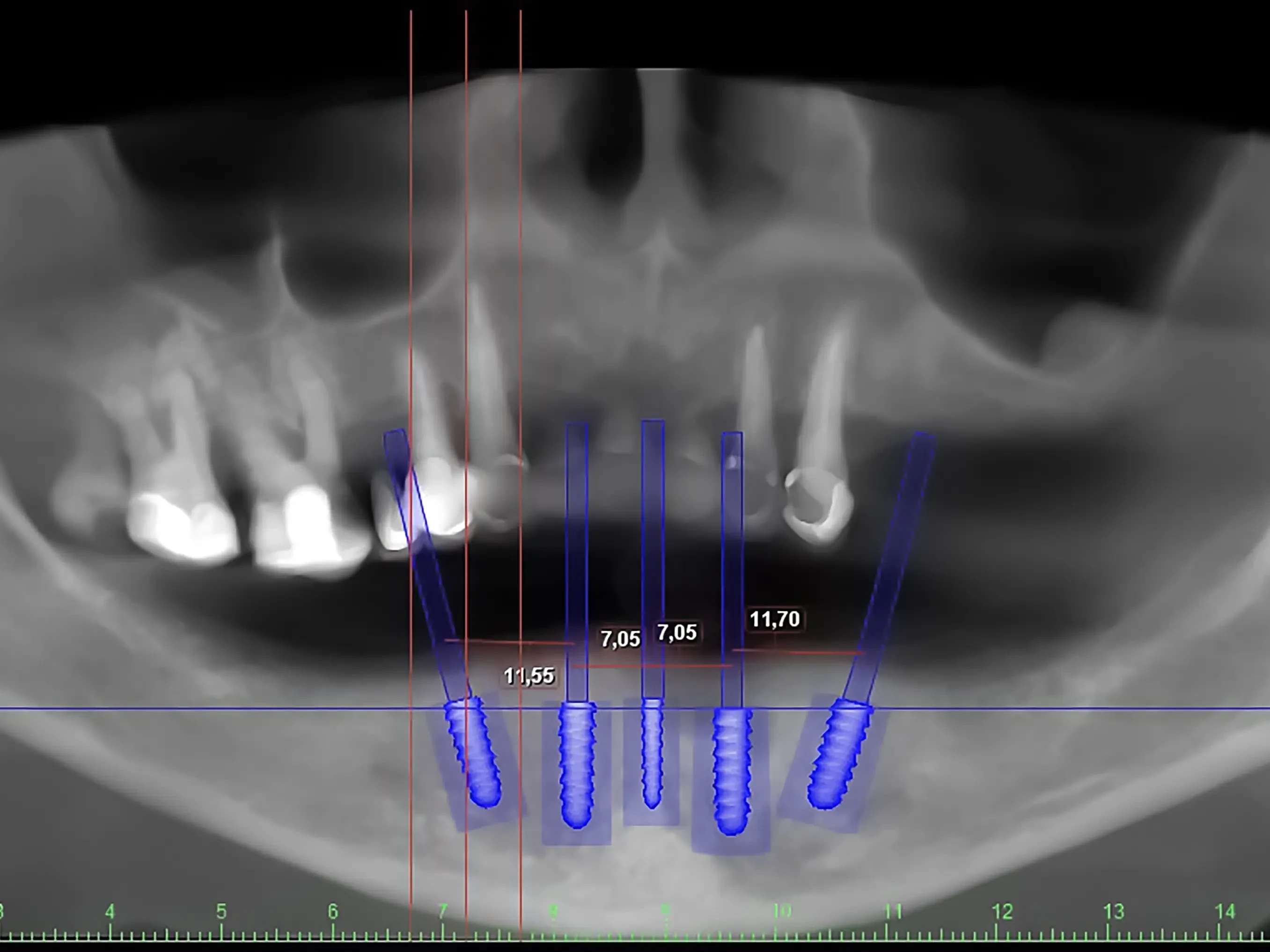 Имплантация зубов без костной пластики