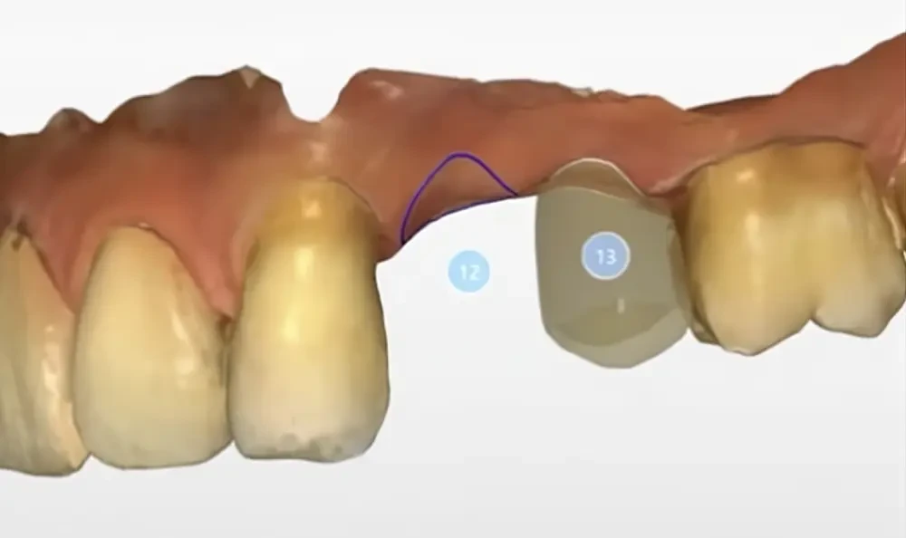 Импланты Osstem в Нижнем Новгороде