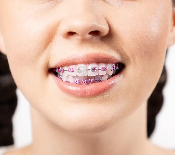 Лигатурные брекеты в Нижнем Новгороде