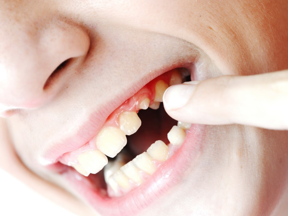 Вставить зуб