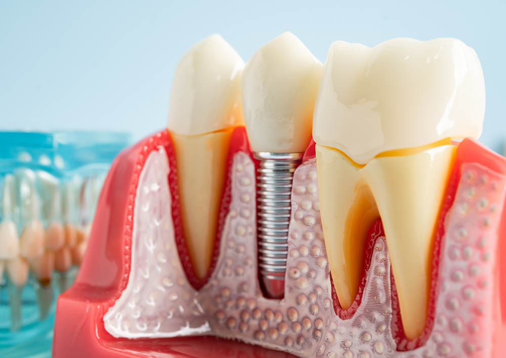 Импланты AnyOne